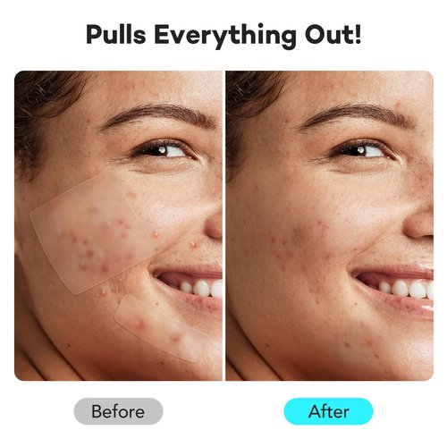 LitBear Large Pimple Patches for Face (6 Sizes 118 Pcs), Big Hydrocolloid Acne Patches, XL Hydrocolloid Bandages for Body, Cheek, Forehead, Chin, Full Face, Back, Nose
