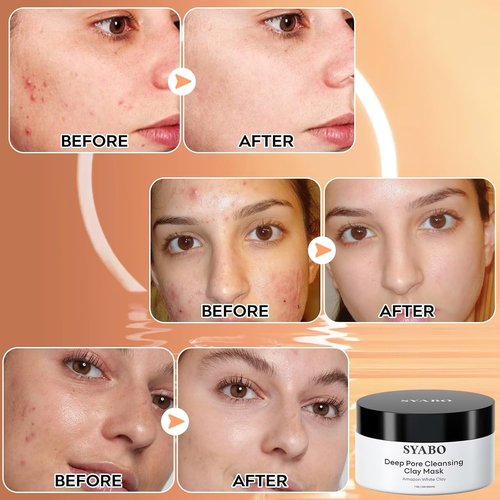 Amazonian White Clay Pore Mask - Refreshing Blackhead Remover for Face, 200ml (7.05 Fl Oz)
