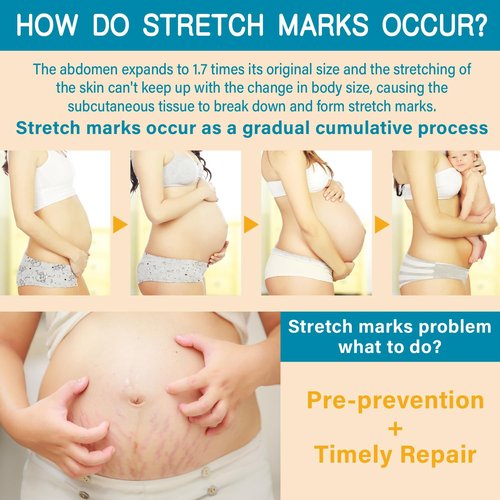 PEGO Stretch Mark Cream - Moisturizing Belly Oil for Pregnancy | Prevent & Reduce Stretch Marks, 300g/10.1 Fl Oz