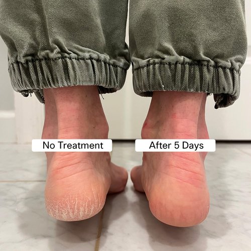 Pedestrian Project Cracked Heel Repair Balm - Smooths & Fills Rough Skin with Shea & Mango Butters | 1 oz