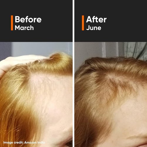 Minimalist Hair Density Serum 18% - Procapil, Capixyl & Anagain for Hair Fall Control | 30 ml