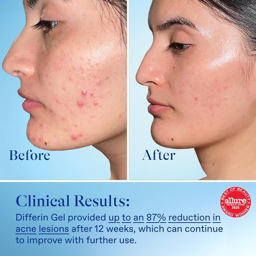Differin Acne Treatment Gel - 0.1% Adapalene Retinoid for Sensitive Skin | 45g Pump, 90-Day Supply