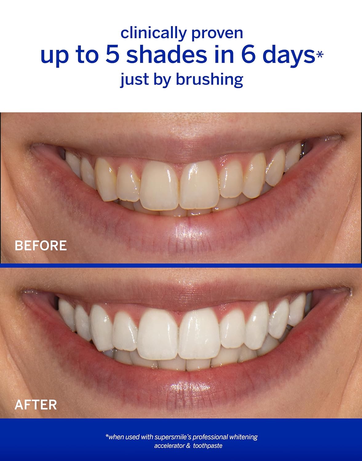 Supersmile Whitening Kit - Original Mint Flavor for Bright, White Teeth | Complete Oral Care Set