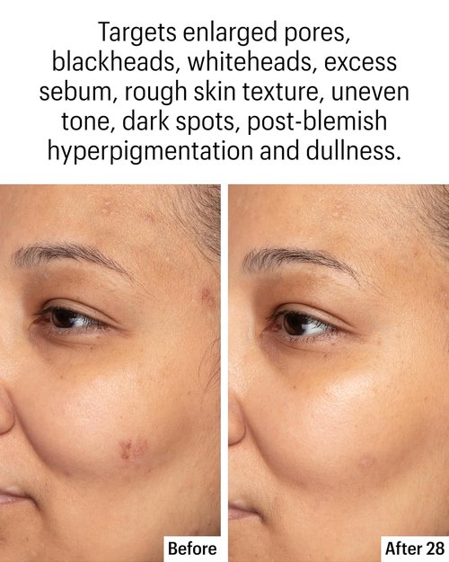 Allies of Skin Azelaic & Kojic Clarifying Face Serum | Clinically Proven for Acne & Blemish Prone Skin |10% Azelaic Acid Treats Pigmentation and Redness | Targets Pores & Uneven Skin Texture (1 Fl oz)