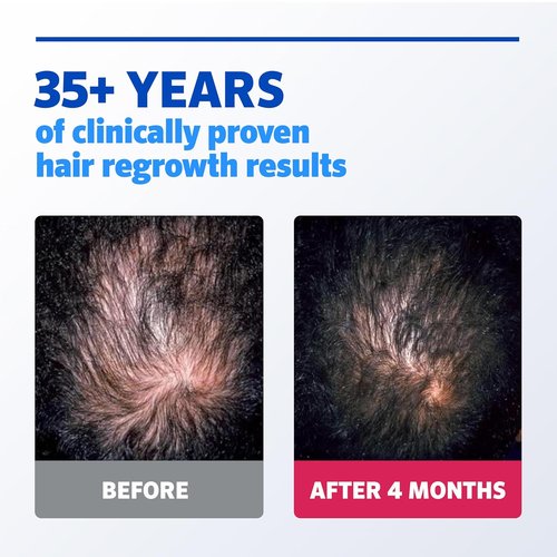 Regine Switzerland Rogaine Extra Strength Minoxidil Solution - Clinically Proven Hair Regrowth Treatment | 3 Bottles, 5% Formula