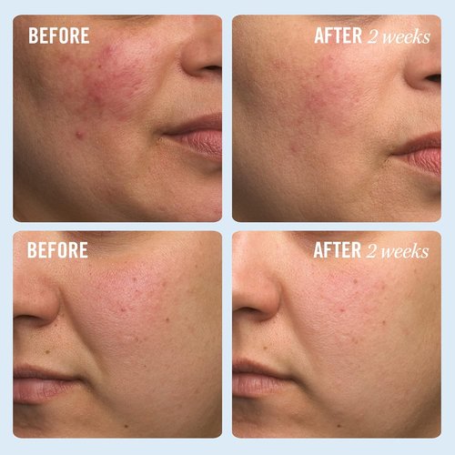 First Aid Beauty - Ultra Repair Cream - Intense Hydration Face & Body Moisturizer - 1 oz for Eczema Relief