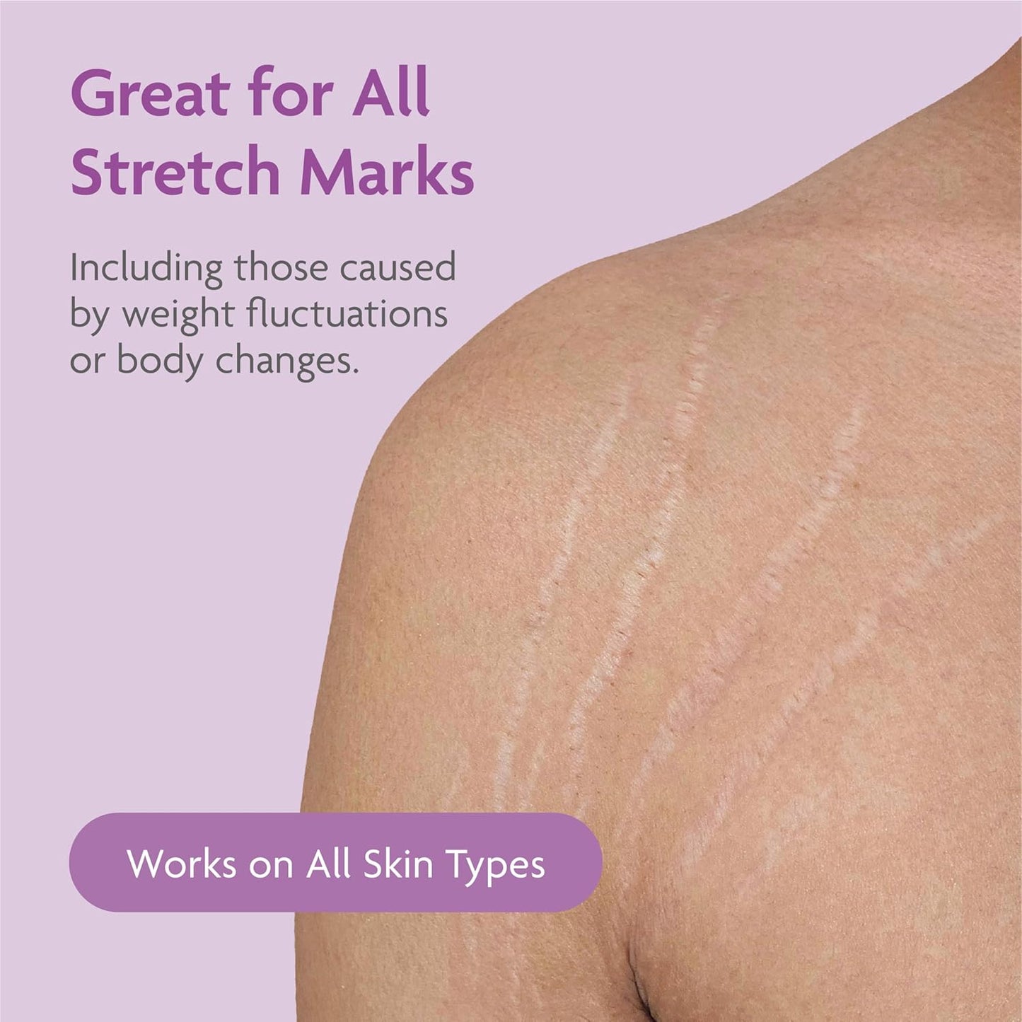TriLASTIN Stretch Mark Cream - Hydrating Body Lotion with Collagen, Niacinamide & Vitamin E - Unscented 5.5 oz