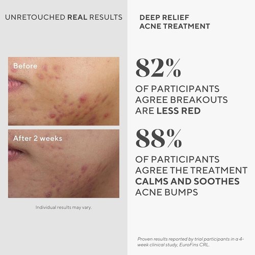 Murad Deep Relief Acne Spot Treatment - 2% Salicylic Acid for Hormonal Acne & Breakouts | 1 Fl Oz