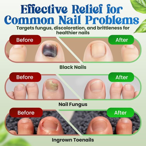 Premium Fungal Nail File Patches Toe Foot Repair Care Extra Fungus Strength 21 Pcs Nighttime Damaged Treatment tolnaftate Toenail ingrown Nails Strengthen 8 Hour Safe Sensitive gift for Women Men.