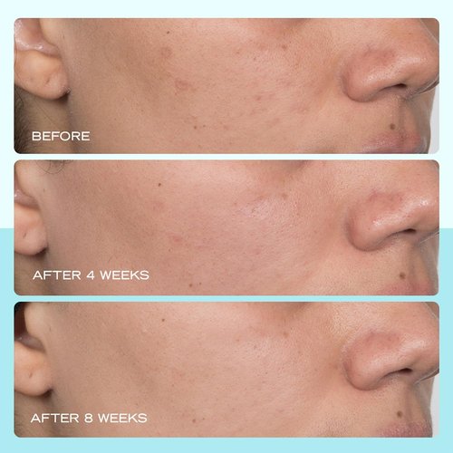 First Aid Beauty - Dark Spot Serum with Niacinamide | Reduces Dark Spots & Hyperpigmentation, 1 oz