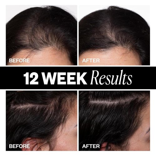 IGK Scalp Treatment for Hair Growth - Thickening Serum for Thinning Hair | Clinically Tested Mist | 2.1 Oz