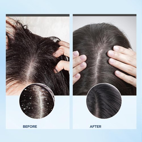 Bablabear Scalp Exfoliator Scrub - Itchy Scalp Treatment for Dandruff Relief | Sulfate-Free Formula