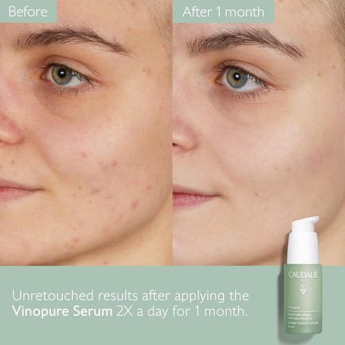 Caudalie Vinopure Acne-Prone Skin Trio - Skin Perfecting Serum, Purifying Gel Cleanser & Spot Solution