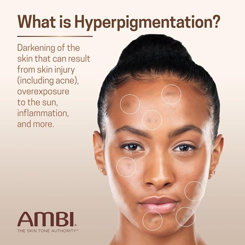 Ambi Even & Clear Fade Serum - Hydroquinone-Free Dark Spot Corrector with Retinol & Niacinamide | 1 Fl Oz