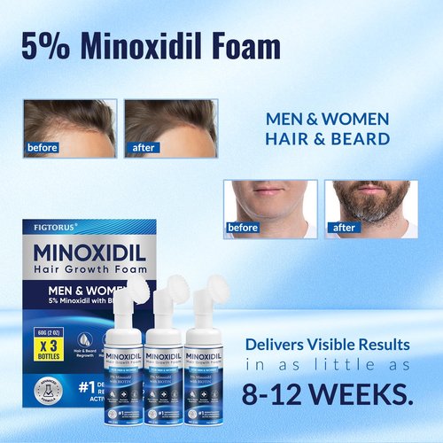 5% Minoxidil Foam, Minoxidil for Men Foam, Minoxidil for Women Hair Growth, Minoxidil for Men and Women. (6 Ounce)