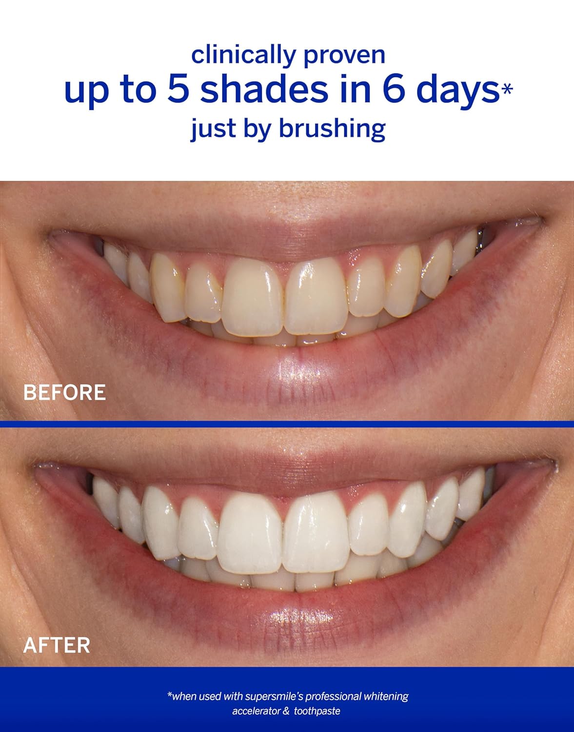Supersmile Professional Whitening Accelerator - Powerful, Safe Whitening Without Sensitivity - 8 oz