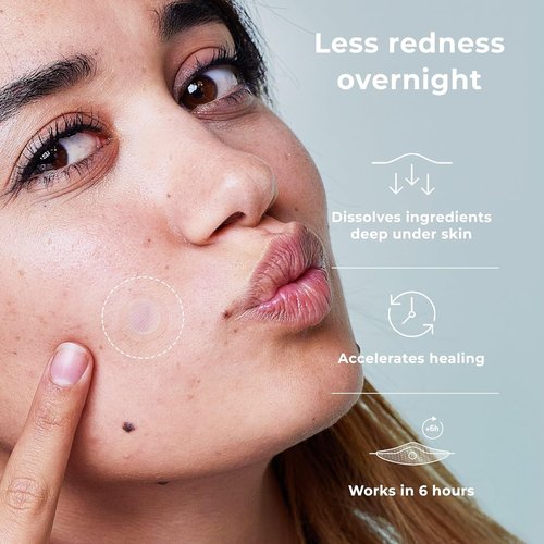 OMMA Korean Microdart Acne Patch - Effective Cystic Acne Treatment with Salicylic Acid & Tea Tree | 17mm Pimple Patches (18 Count)