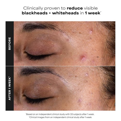 Paula's Choice SKIN PERFECTING 2% BHA Exfoliating Pads - Clear Blackheads & Minimize Pores