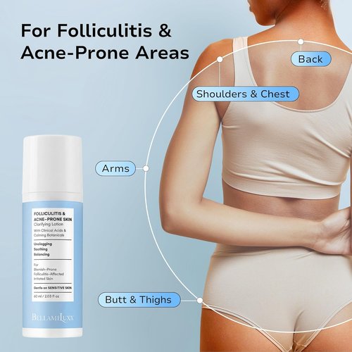 BellamiLuxx Folliculitis Acne Lotion - Reduces Itch, Redness & Body Acne with Salicylic Acid | Gentle Care for Sensitive Skin