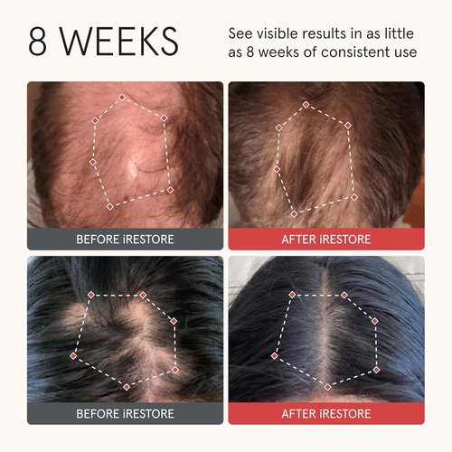 iRestore Anti Hair Loss Shampoo - Biotin Formula for Thicker, Voluminous Hair Growth | For Men & Women
