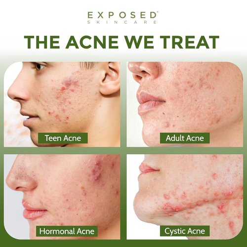 Exposed Skin Care Acne Treatment Kit - Clear Teen & Adult Acne with 2.5% Salicylic Acid & 3.5% Benzoyl Peroxide | Natural & Cruelty-Free