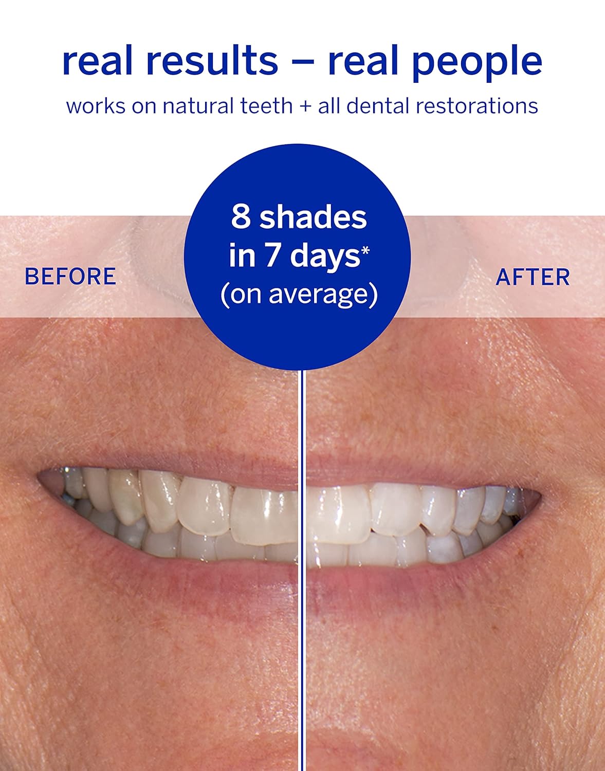 Supersmile Whitening Strips - Professional Enamel Safe Teeth Whitener for Sensitive Teeth