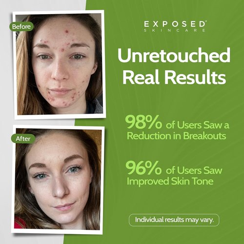 Exposed Skin Care Acne Treatment Kit - Clear Teen & Adult Acne with 2.5% Salicylic Acid & 3.5% Benzoyl Peroxide | Natural & Cruelty-Free