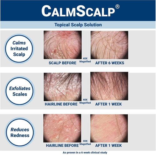 Scalp Treatment by [Brand Name] - Itch Relief & Exfoliation for Healthier Hair | 4 oz Made in USA