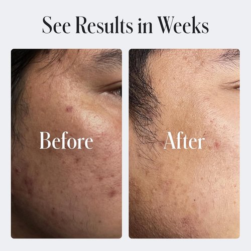 Geologie Skin Repair Moisturizer - Retinol Resurfacing Face Cream for Blemish Prone Skin | 60 ML