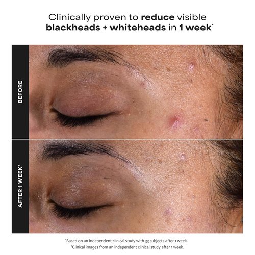 Paula's Choice SKIN PERFECTING 2% BHA Liquid Exfoliant - Salicylic Acid Facial Polish for Enlarged Pores & Fine Lines - Fragrance-Free