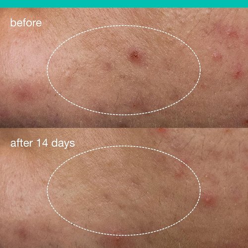 Dermalogica Deep Acne Liquid Patch, Sulfur Acne Treatment with Niacinamide, Invisible Spot Treatment for Blemish-Prone Skin – 0.5 fl oz