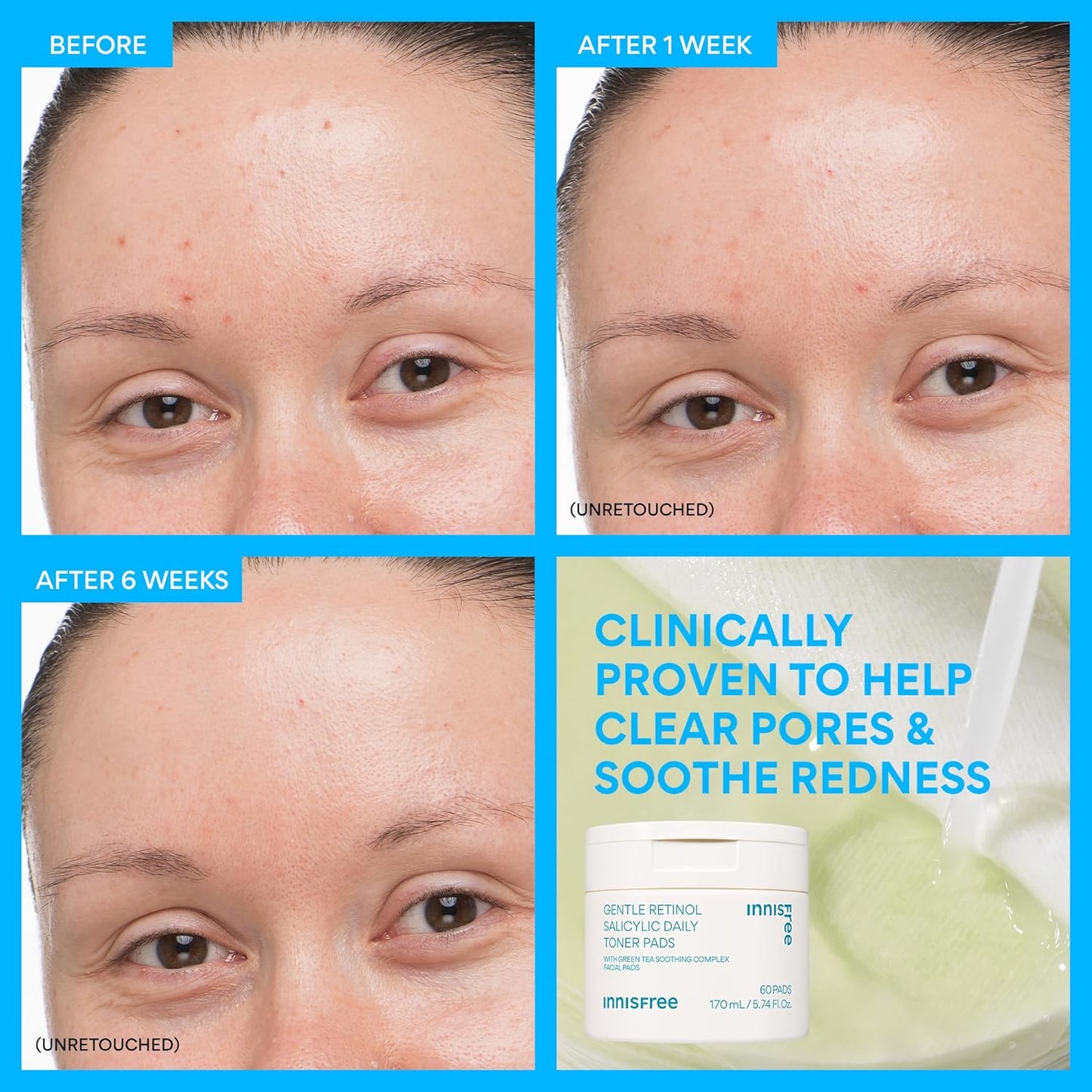 Innisfree Daily Gentle Retinol Toner Pads - Acne-Prone Skin Care | Korean Sheet Mask Pads