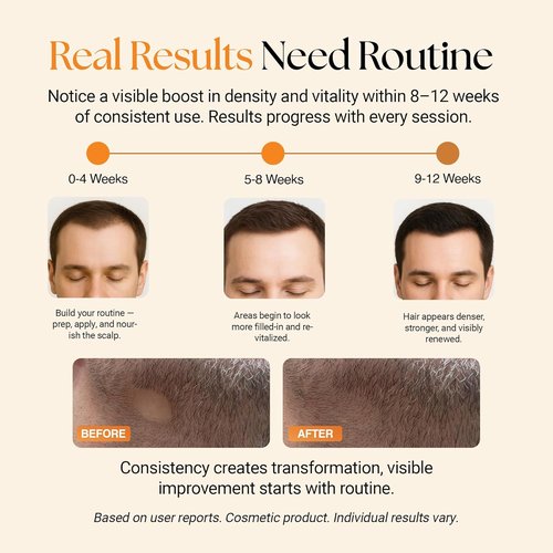 ReGlow Micro-Infusion Hair Density System - Precision Applicators & Bio-Active Serum for Fuller Hair | 6 Applications