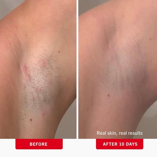 First Aid Beauty - Ingrown Hair Treatment Pads with BHA & AHA - Prevent Razor Bumps & Exfoliate - 60 Compostable Pads