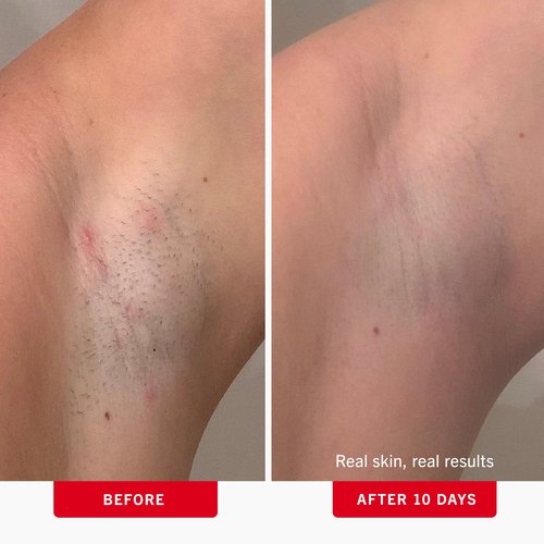 First Aid Beauty - Ingrown Hair Pads
