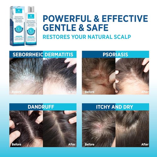 Roycederm Seborrheic Dermatitis Shampoo & Conditioner Set - Soothing Herbal Treatment for Scalp Issues | Moisturizing Formula
