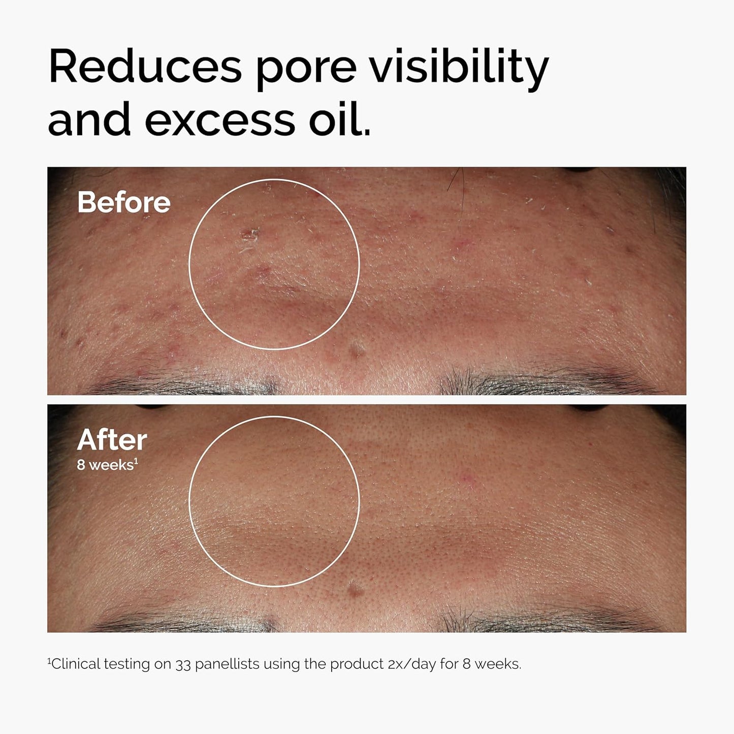 The Ordinary Niacinamide 10% + Zinc 1% Serum - Smoothing Formula for Blemish-Prone Skin