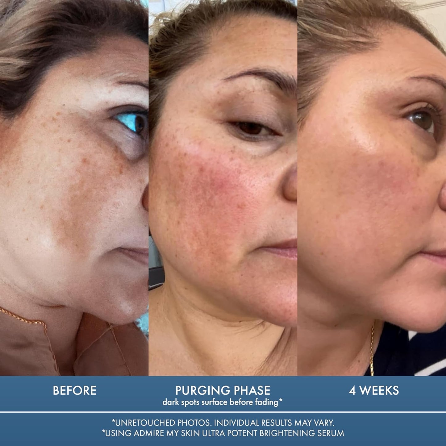 Admire My Skin Dark Spot Corrector Serum - Brightening Kojic & Azelaic Acid Formula | 1oz