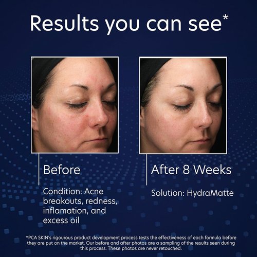 PCA SKIN HydraMatte Oil Control Moisturizer - Quick Absorption for Oily Skin | 1.8 oz Jar