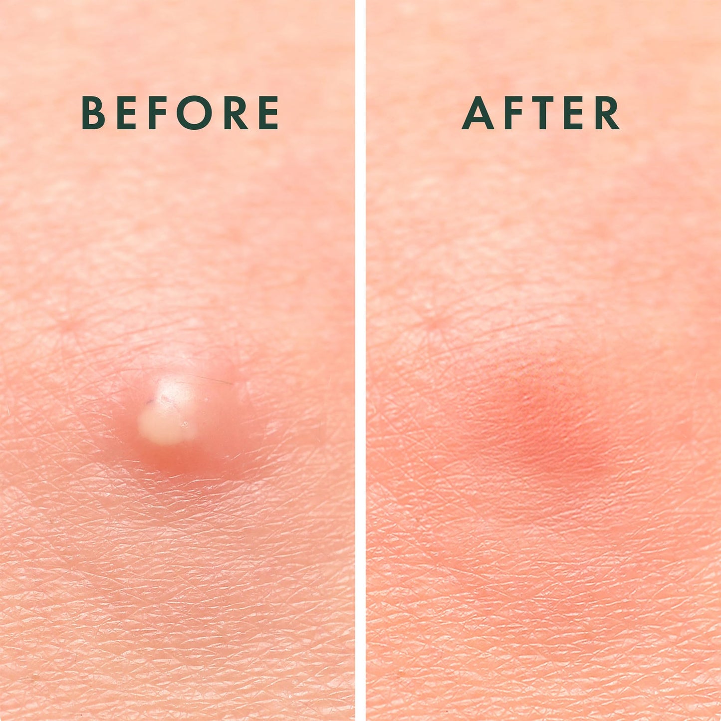 Rael Pimple Patches, Miracle Invisible Spot Cover - Hydrocolloid Acne Pimple Patch, Absorbs Zits & Blemish, Korean Skin Care, 2 Sizes (96 Count)