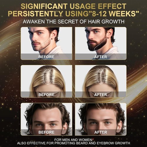 Regine Switzerland 5% Minoxidil Foam - Fast Absorbing Hair Growth Treatment for Thinning Hair | 3 Month Supply (3 x 2.12 oz)
