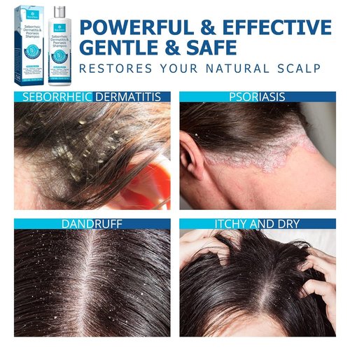 Roycederm Seborrheic Dermatitis Shampoo - Relieves Itching & Flaking for Dry, Itchy Scalp