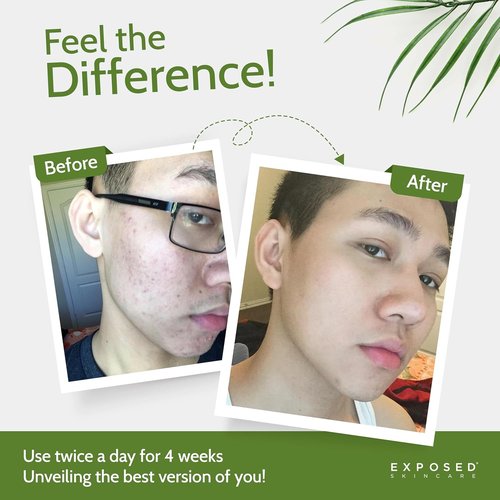 Exposed Skin Care Acne Treatment Kit - Clear Teen & Adult Acne with 2.5% Salicylic Acid & 3.5% Benzoyl Peroxide | Natural & Cruelty-Free