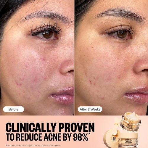 Peace Out Acne Gel Moisturizer - 2% Salicylic Acid & Niacinamide for Oily Skin | 1.69 fl oz