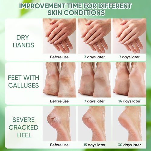 Urea Cream 50 Percent for Feet with Coconut 5.29 oz || Foot & Hand Cream Maximum Strength with 2% Salicylic Acid, Tea Tree and Aloe Vera for Deep Moisturizing and Callus Removing (Upgraded Formula)