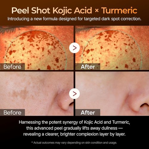 Dr. Melaxin Kojic Acid Turmeric Serum - Exfoliating Dark Spot Corrector with AHA/BHA & Niacinamide (80ml)