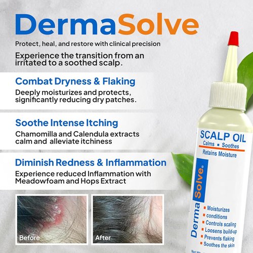 Dermasolve Scalp Oil - Flaky Scalp Relief for Psoriasis & Dandruff - 4 oz, Dermatologist Approved