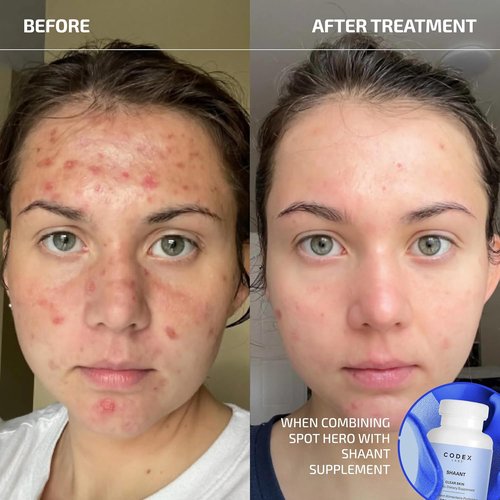 Codex Labs Shaant Spot Hero - 5% Sulfur Acne Treatment | Clinically Tested Formula for Sensitive Skin | 0.5 oz