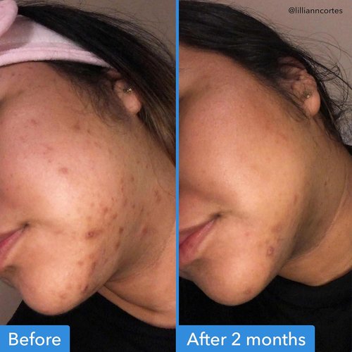 Good Molecules Discoloration Correcting Serum - Target Dark Spots & Hyperpigmentation - 1 FL Oz Skin Care