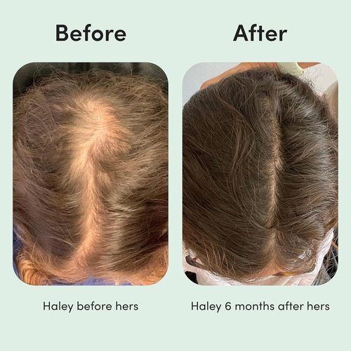 Hers Hair Regrowth Treatment - Minoxidil 2% Solution for Women - Promotes Thicker, Fuller Hair - Unscented, 2 Pack